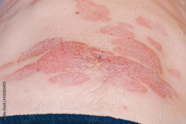 Obraz Large red inflamed scaly rash on the stomach.Acute psoriasis on the stomach in a man, severe redness on the skin, an autoimmune incurable dermatological skin disease. Red redness, spots on the skin.