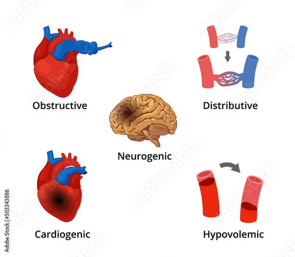 Obraz 5 types of shock infographics. The diagram with the illustrations of five types of shock