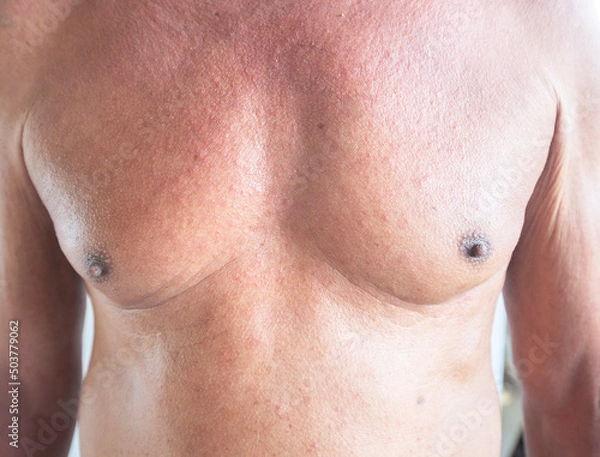 Obraz Red rash on the human body