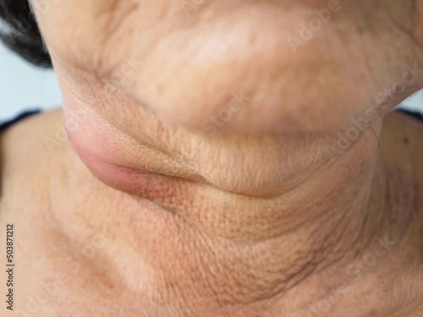 Obraz Woman neck lymph node inflammation. closeup photo, blurred.