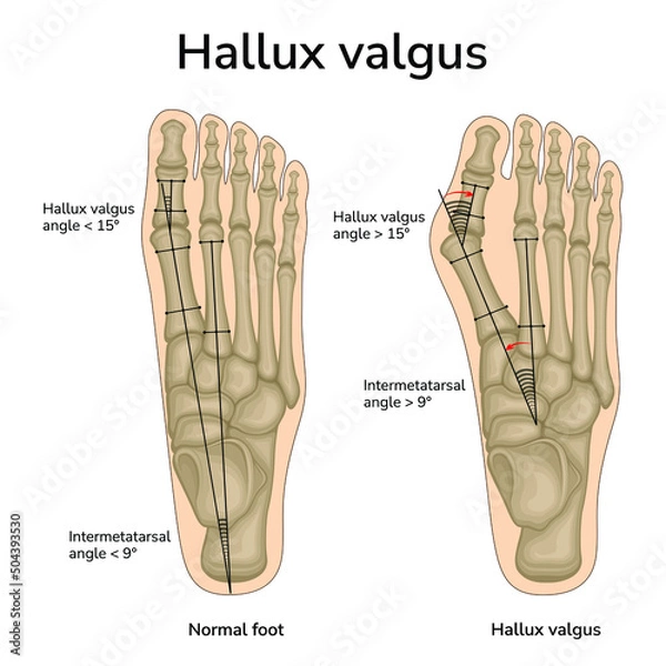 Fototapeta An illustration of the location of the bones in a healthy foot and hallux valgus. The angles of the bones relative to each other are indicated