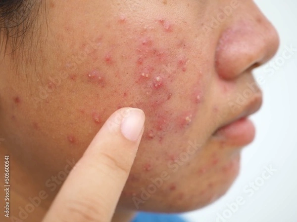 Obraz Teenage girl with acne problem on white background. Beauty concept. Closeup photo, blurred.
