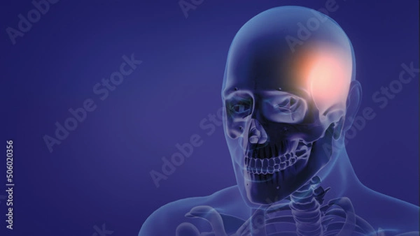 Fototapeta Animation of a painful Headache	