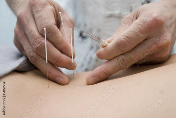 Obraz Treatment by acupuncture