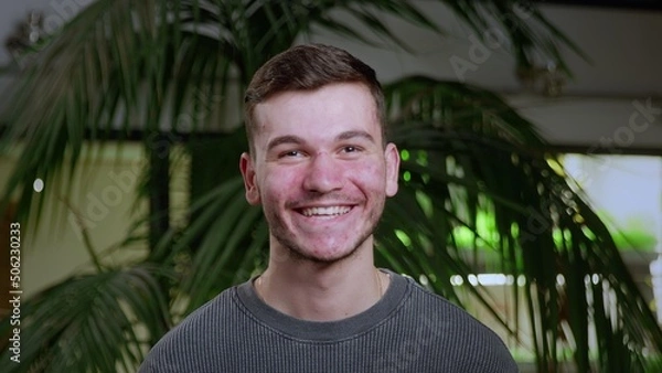 Obraz Close-up of a young man with pimples on his face. The guy laughs. Problematic skin