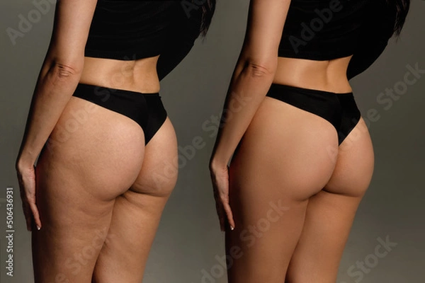Fototapeta Buttocks and hips woman with cellulite and stretch marks close-up before and after liposuction procedure and cosmetic therapy