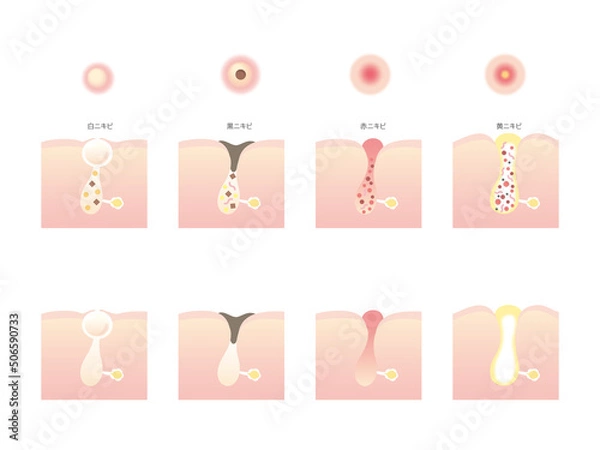 Obraz 色々なニキビのイラスト