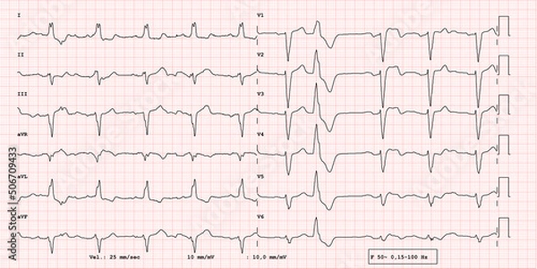 Fototapeta Pathological 12-lead ECG, right branch block, supraventricular premature beat,  BAV atrioventricular block first degree, real exam