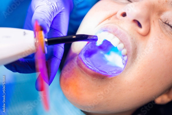 Fototapeta Tooth restoration with filling and polymerization lamp. Dental curing light setting composite resins.