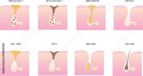 Fototapeta 毛穴汚れの種類のイラスト