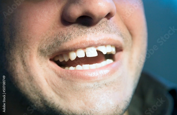Fototapeta Patient Has a Broken Teeth