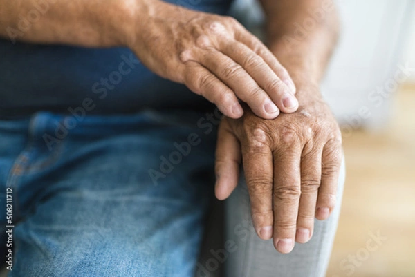 Fototapeta Elderly man suffering from psoriasis on hands