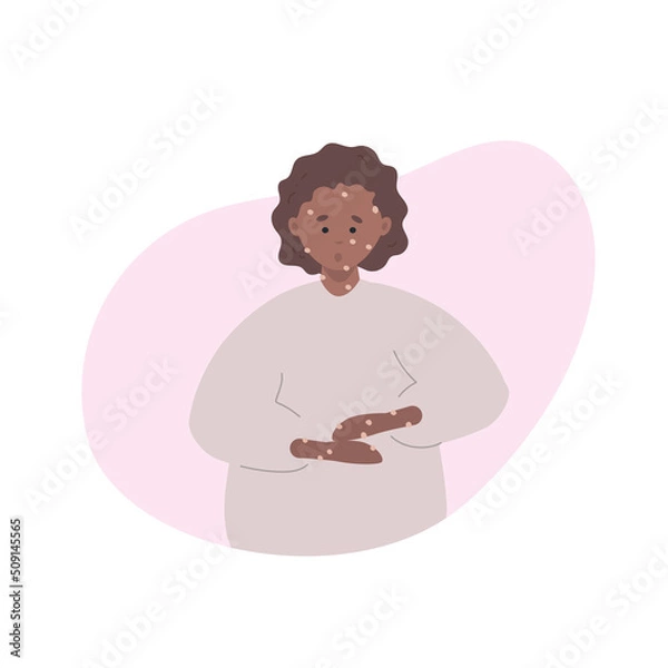 Fototapeta Rash on African female hands and face. Monkey pox symptoms. World epidemic outbreak. Disease spread awareness. Vector illustration in flat style.