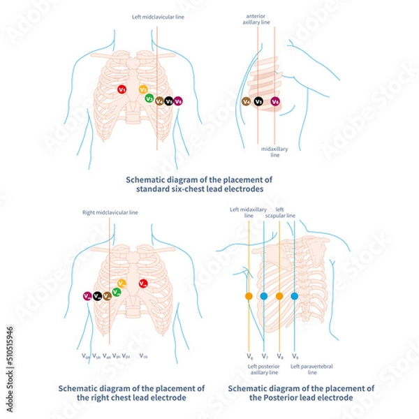 Fototapeta The chest electrode of ECG includes conventional chest lead, posterior wall lead and right ventricular lead. The placement of chest lead electrode shall comply with the specification.
