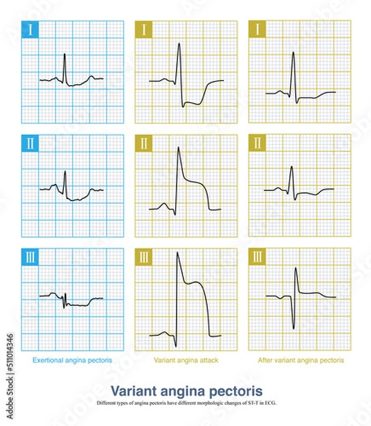 Obraz Different types of angina pectoris have different ECG patterns: exertional angina pectoris shows ST segment depression, variant angina pectoris shows ST segment elevation.