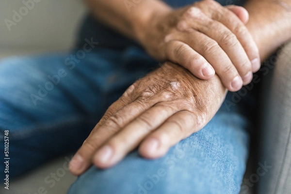Fototapeta Elderly man suffering from psoriasis on hands