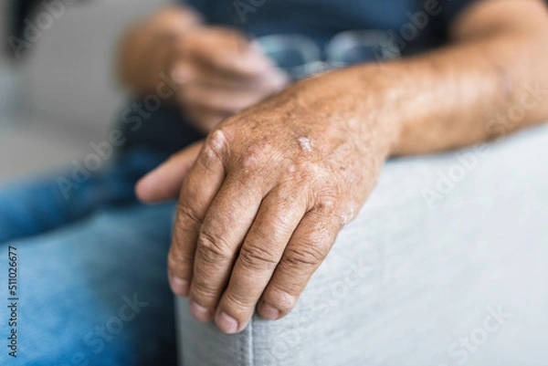 Fototapeta Elderly man suffering from psoriasis on hands