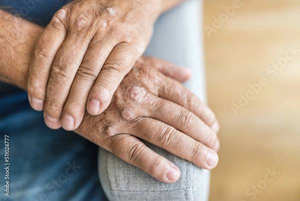 Fototapeta Elderly man suffering from psoriasis on hands