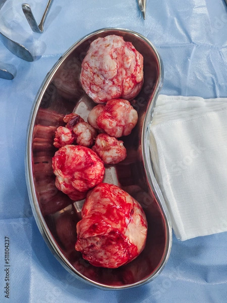 Fototapeta A picture of a fibroid (multiple myoma) surgically removed from the uterus of a patient 
