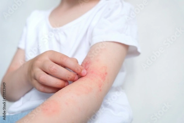 Obraz The child scratches atopic skin. The child applies a special cream to atopic skin. Dermatitis, diathesis, allergy on the child's body.	