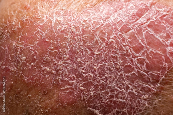 Fototapeta Psoriasis is the abdomen on white background.