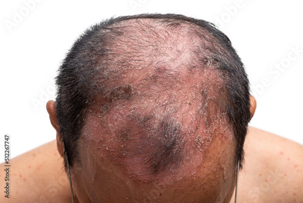 Fototapeta Top Shot, Psoriasis is that head-on white background.