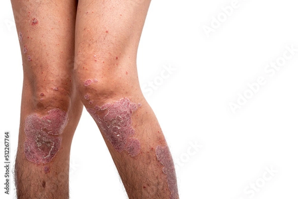 Fototapeta Psoriasis is that knee on white background.