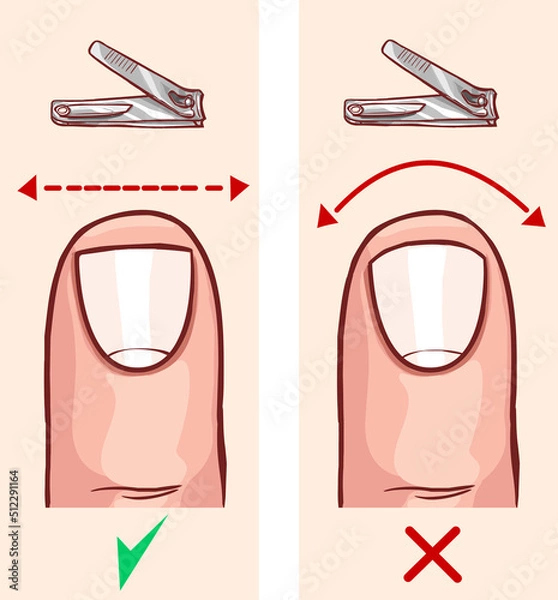 Obraz Correct and incorrect fingernail cut