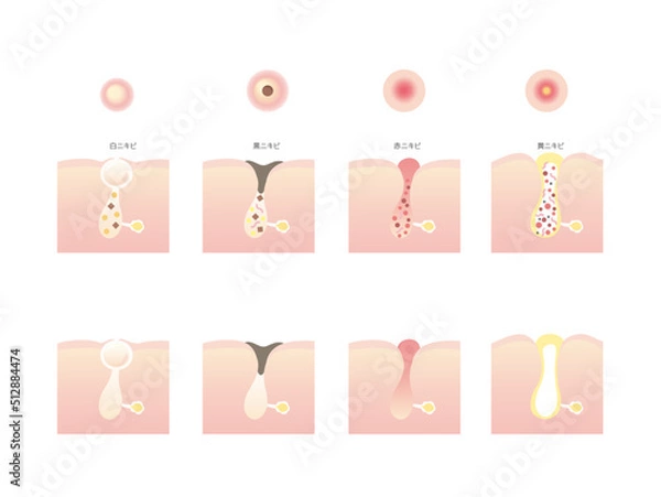Obraz ニキビの種類のイラスト