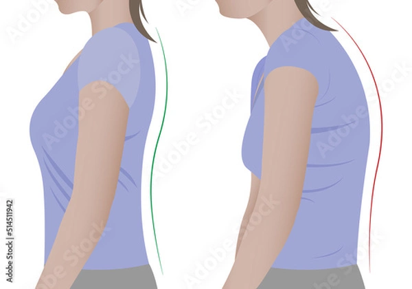 Fototapeta Illustration of a woman's back with a healthy spine and with scoliosis, a bent spine. Vector