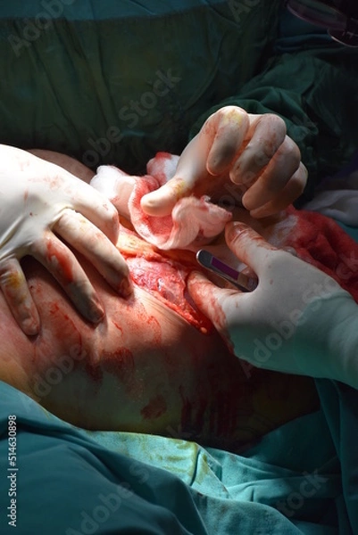 Obraz Plastic surgeon doing breast implant. Breast augmentation and reduction surgery