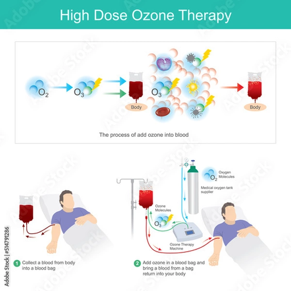 Fototapeta High Dose Ozone Therapy. This process add ozone in a blood bag and bring a blood from a bag return into your body..
