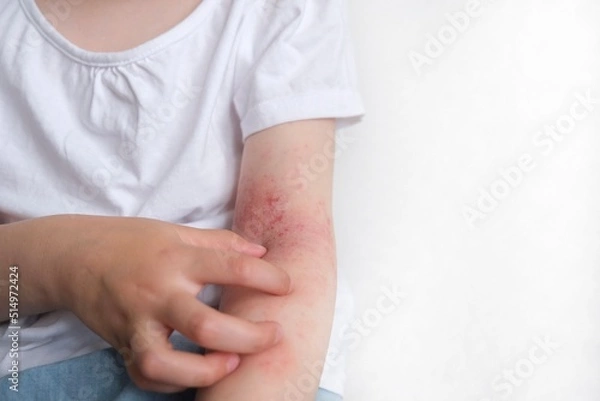 Obraz The child scratches atopic skin. Dermatitis, diathesis, allergy on the child's body.
