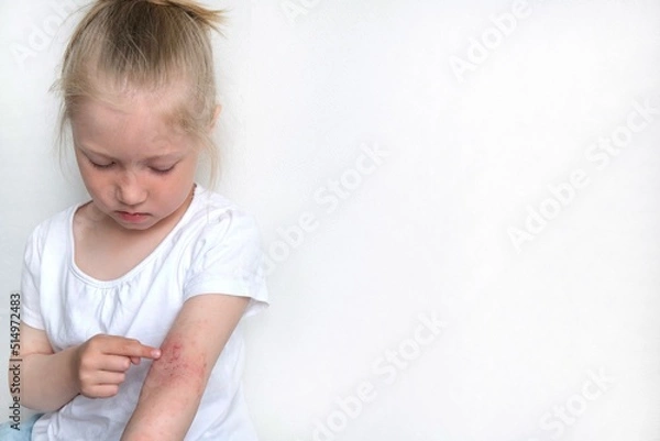 Obraz The child scratches atopic skin. Dermatitis, diathesis, allergy on the child's body.