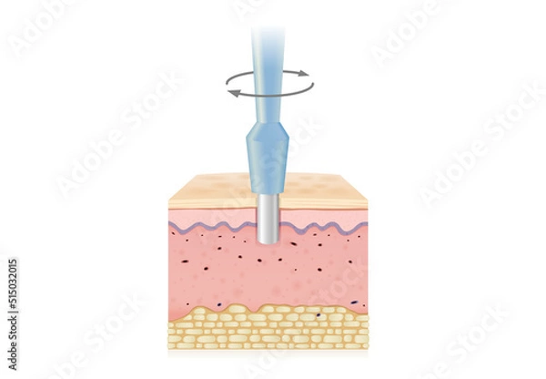 Obraz Turn the medical instrument and cut down to the skin layer to get sample tissue. Illustration about Biopsy punches for medical diagnosis and skin cancer treatment.