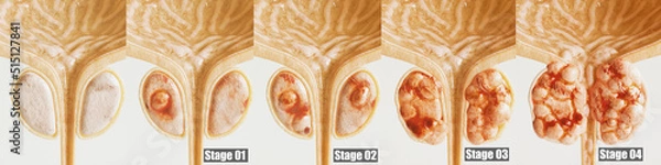 Fototapeta Prostate cancer all 4 stages - detailed close-up - 3D rendering