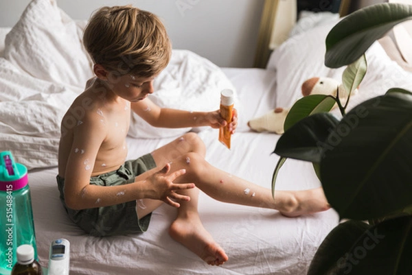 Fototapeta applying cream onto skin of little boy with chickenpox at home