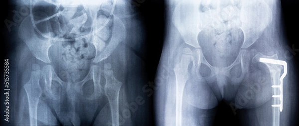 Fototapeta X-ray before and after surgery. Femoral osteotomy. X-ray film of the pelvis: dysplasia of the left hip, close-up of the metal plate