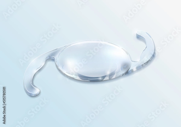 Obraz Cataract surgery, intraocular lens that will restore your vision. Corrective eyewear. Intraocular Lens Dislocation (IOL)