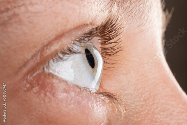 Fototapeta female eye diagnosed with keratoconus corneal thinning.