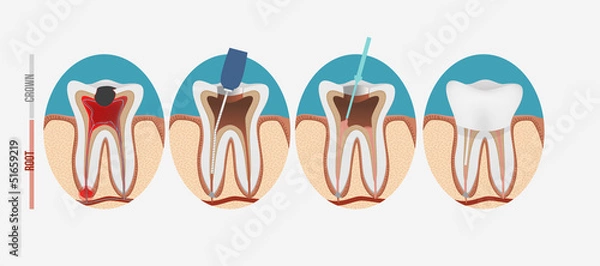 Obraz Proces kanałowy