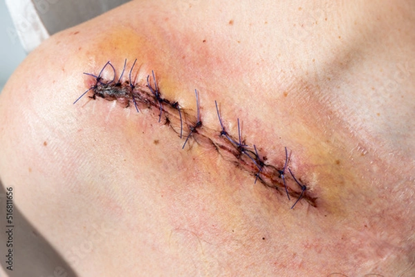 Fototapeta Suture wound after fracture of the right clavicle after surgery, close up image