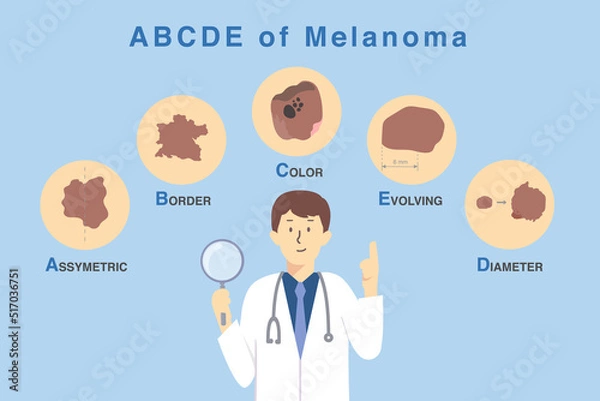 Obraz Doctor holding magnifies glass with 5 characteristics of skin damage from cancer cell. Illustration about diagnosis and classification of melanoma by use ABCDE letter.