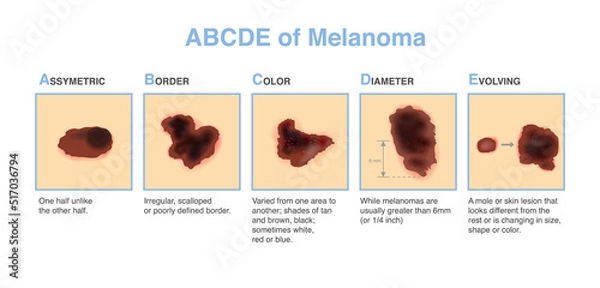 Fototapeta Different characteristics of skin damage. ABCDE stands for asymmetry, border, color, diameter, and evolving. Medical diagram for diagnosing and classifying melanomas and treatment.