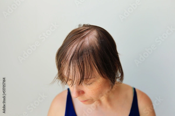 Fototapeta Hair loss in the form of alopecia areata. Bald head of a woman. Hair thinning after covid. Bald patches of total alopecia