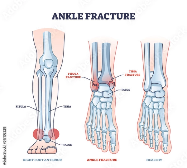 Obraz Ankle fracture and right foot anterior trauma medical view outline diagram. Labeled educational scheme with anatomical comparison for healthy and fractured bones vector illustration. Leg tibia injury