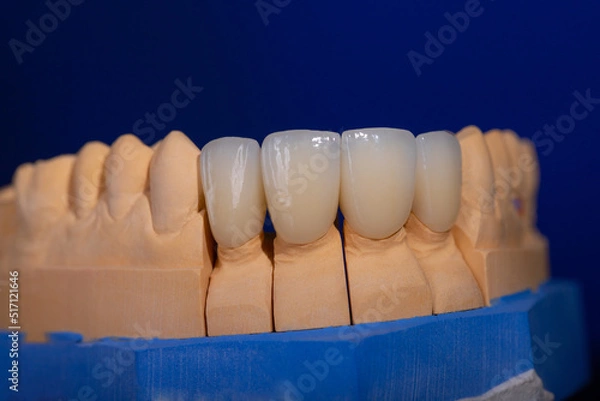 Fototapeta Frames of ceramic crowns on a gypsum model. Zirconia crowns. Metal-free ceramics at the manufacturing stage. Close-up, black isolate