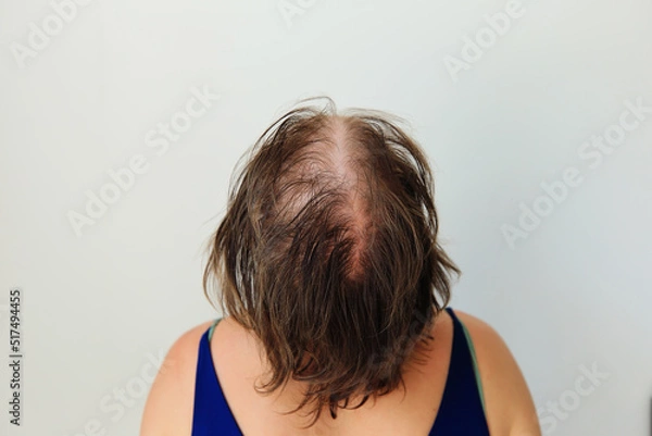 Fototapeta Hair loss in the form of alopecia areata. Bald head of a woman. Hair thinning after covid. Bald patches of total alopecia