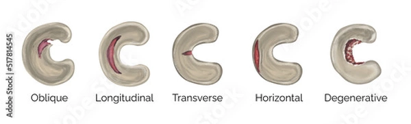 Obraz Types of meniscus injury tear