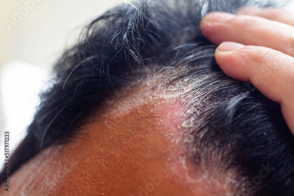 Fototapeta skin disease at the head, Dandruff is a common condition that causes the skin on the scalp to flake